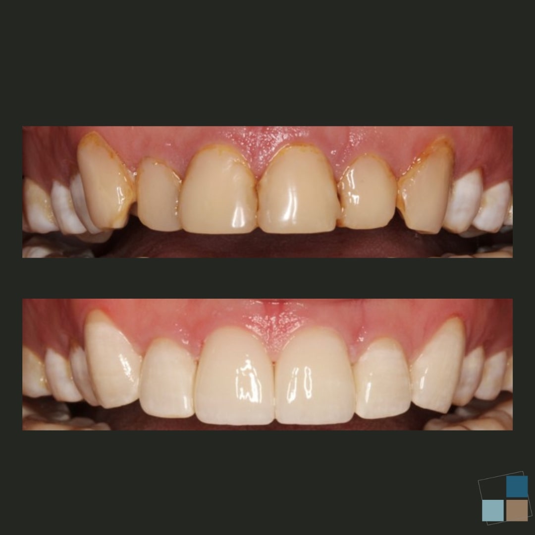 Close up of upper row of teeth before and after cosmetic dentistry treatment