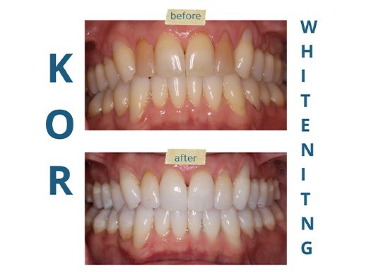 Close up of smile before and after teeth whitening in West Hartford and Avon