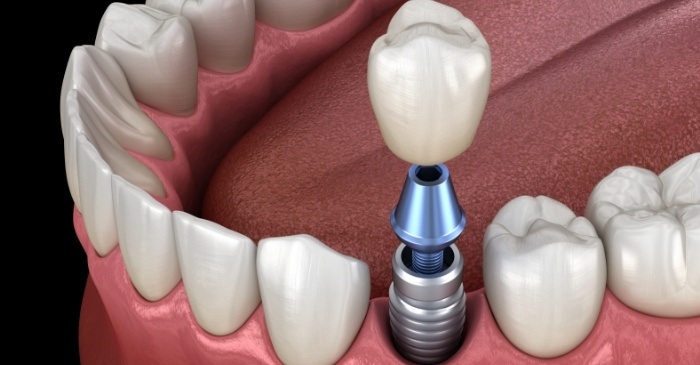 Dental crown being placed onto a dental implant