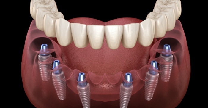 Full denture being placed onto six dental implants