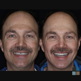 Man smiling before and after getting gap between two front teeth fixed
