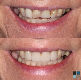 Close up of teeth before and after orthodontics and whitening