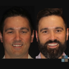 Man smiling before and after cosmetic dental work