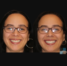 Woman with glasses smiling before and after cosmetic dental work