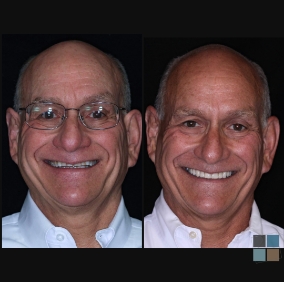 Senior man smiling before and after cosmetic dental work