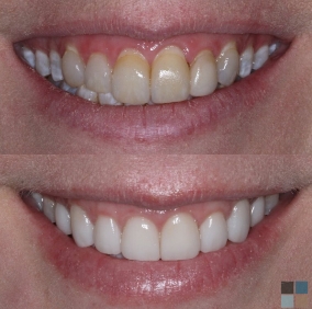 Close up of teeth before and after cosmetic dental work