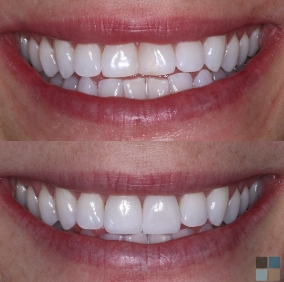 Close up of white teeth before and after orthodontics