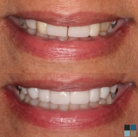 Close up of teeth before and after whitening