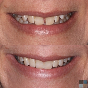 Close up of smile before and after correcting gap between two front teeth