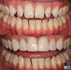 Close up of teeth before and after cosmetic dentistry treatment