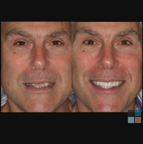 Man smiling before and after getting gap between two front teeth fixed