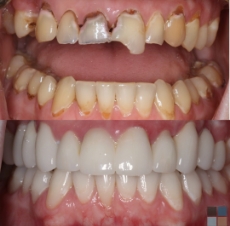 Close up of teeth before and after extensive dental work