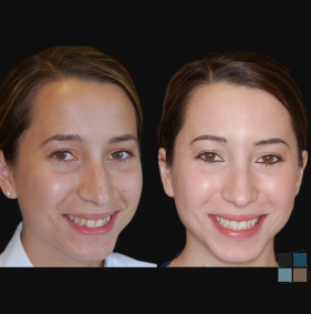 Brunette woman smiling before and after orthodontic treatment from Doctor Wu