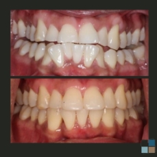 Close up of teeth before and after cosmetic dental work