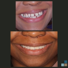 Close up of smile before and after orthodontic work