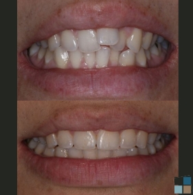 Close up of teeth before and after orthodontics