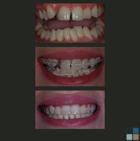 Close up of teeth before during and after Six Month Smiles treatment