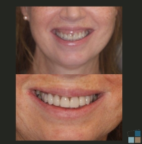 Woman grinning before and after gummy smile correction