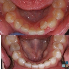 Lower row of teeth before and after correcting misalignment