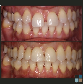 Close up of teeth before and after fixing crowding