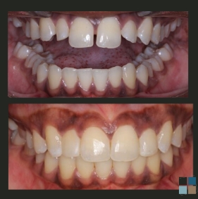 Close up of teeth before and after fixing slight gaps between teeth