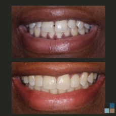 Smile before and after fixing gap between two front teeth