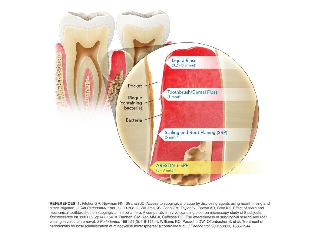 Close up diagram of a tooth and gums