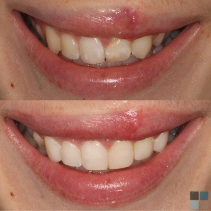 photos of smile before and after dental work