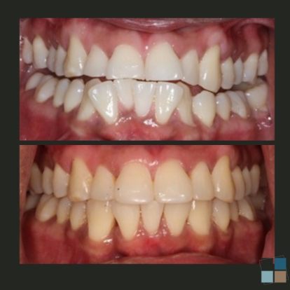 photos of smile before and after dental work