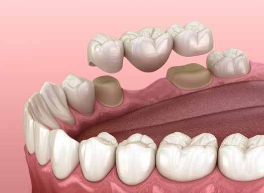 Illustrated dental bridge being fitted to replace a missing tooth