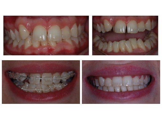 Close up of teeth before during and after orthodontic treatment with Six Month Smiles