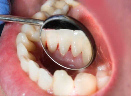 Close up of dental mirror reflecting red spot in gums