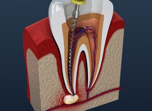 Illustrated dental instrument cleaning inside of a tooth
