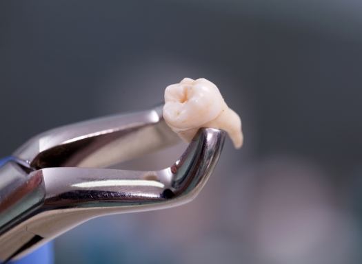 Dental forceps holding a tooth after tooth extractions in West Hartford and Avon