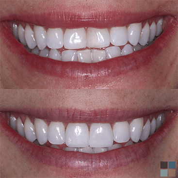 Close up of smile before and after correcting slightly crooked teeth