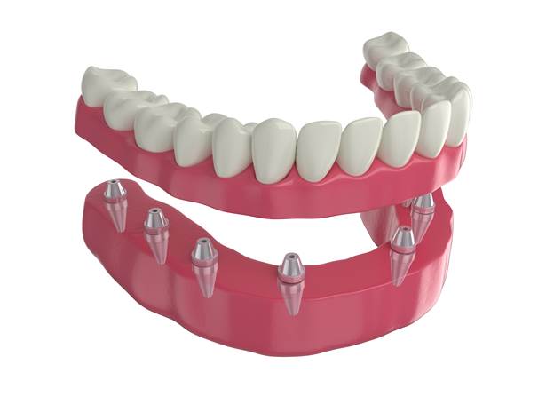 3D render of implant dentures