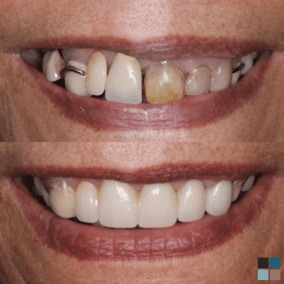 Close up of smile before and after cosmetic dentistry