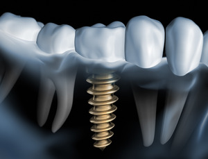 3D render of dentures